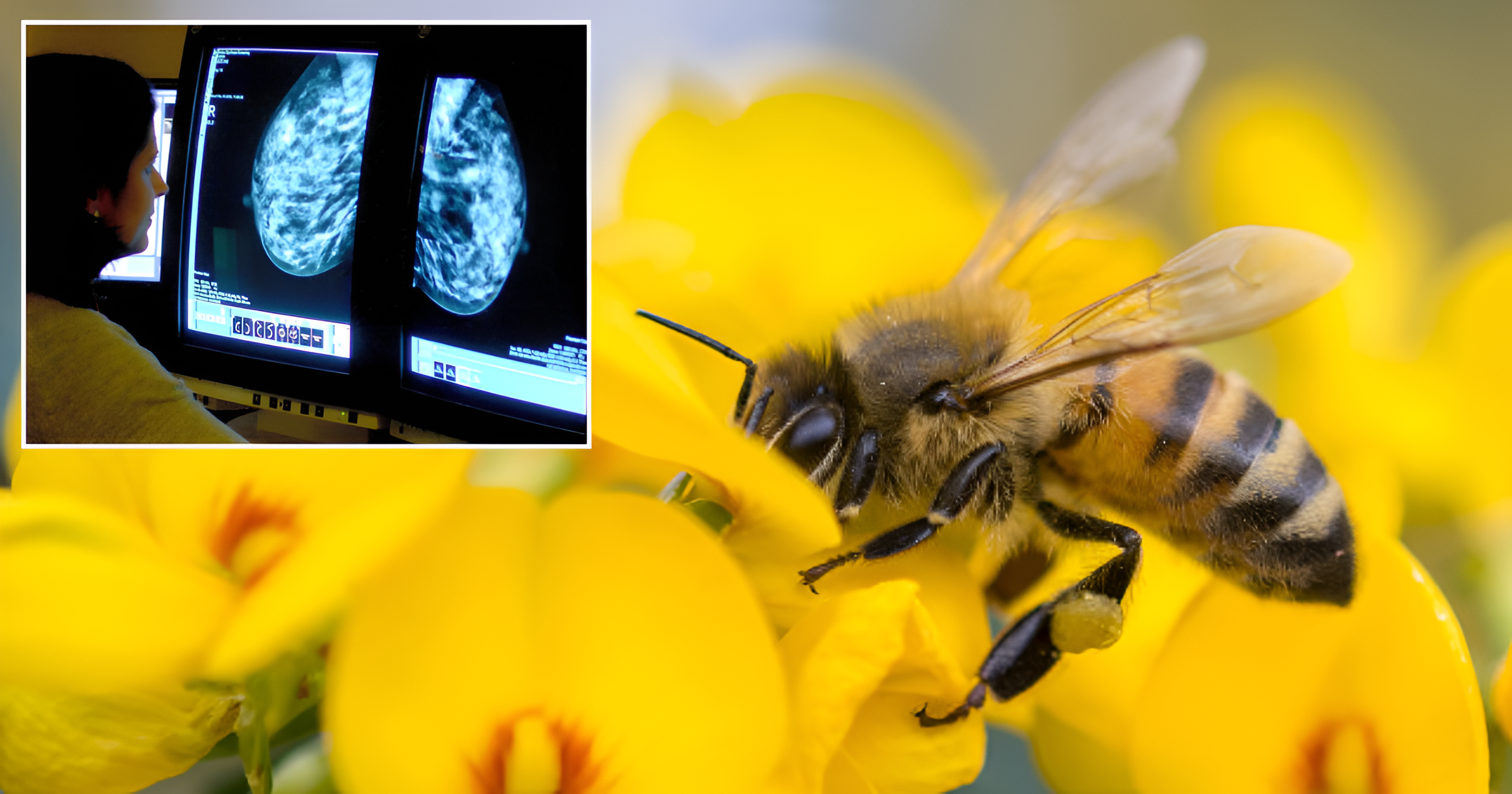 Bee Venom Breakthrough Melittin’s Fight Against Breast Cancer